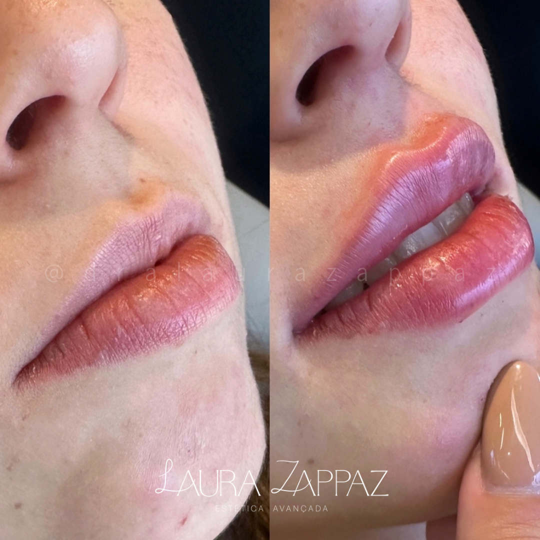 1-Preenchimento-labial