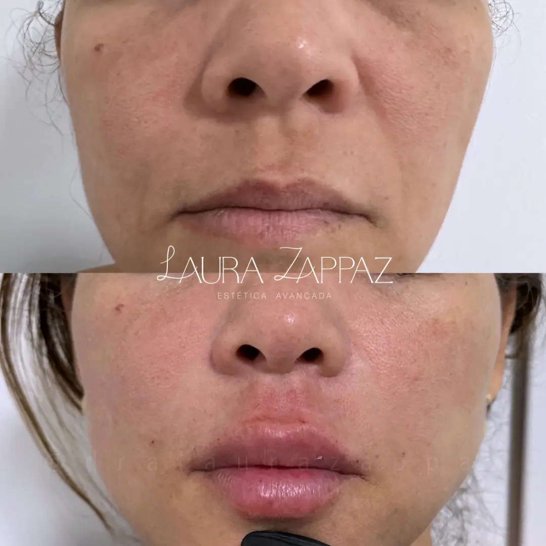11 - Preenchimento labial, preenchimento de bigode chinês e bioestimulador de colágeno