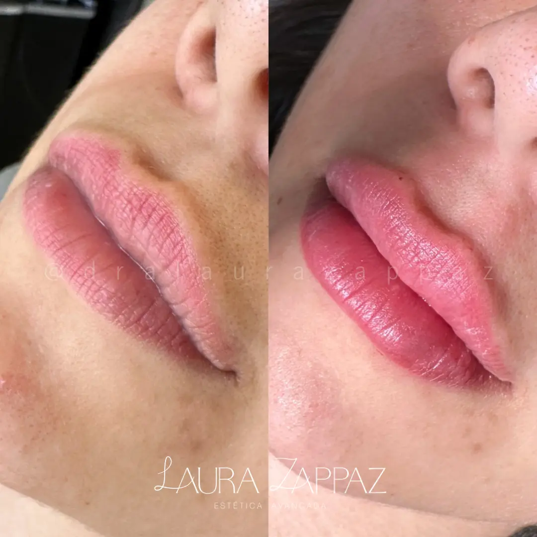 12 - Preenchimento labial