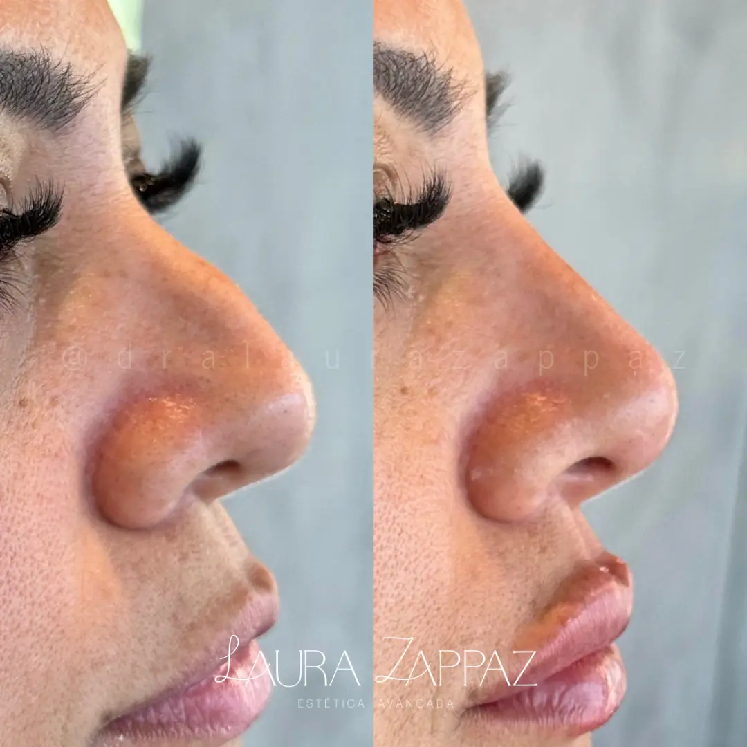 13 - Rinomodelação e preenchimento labial