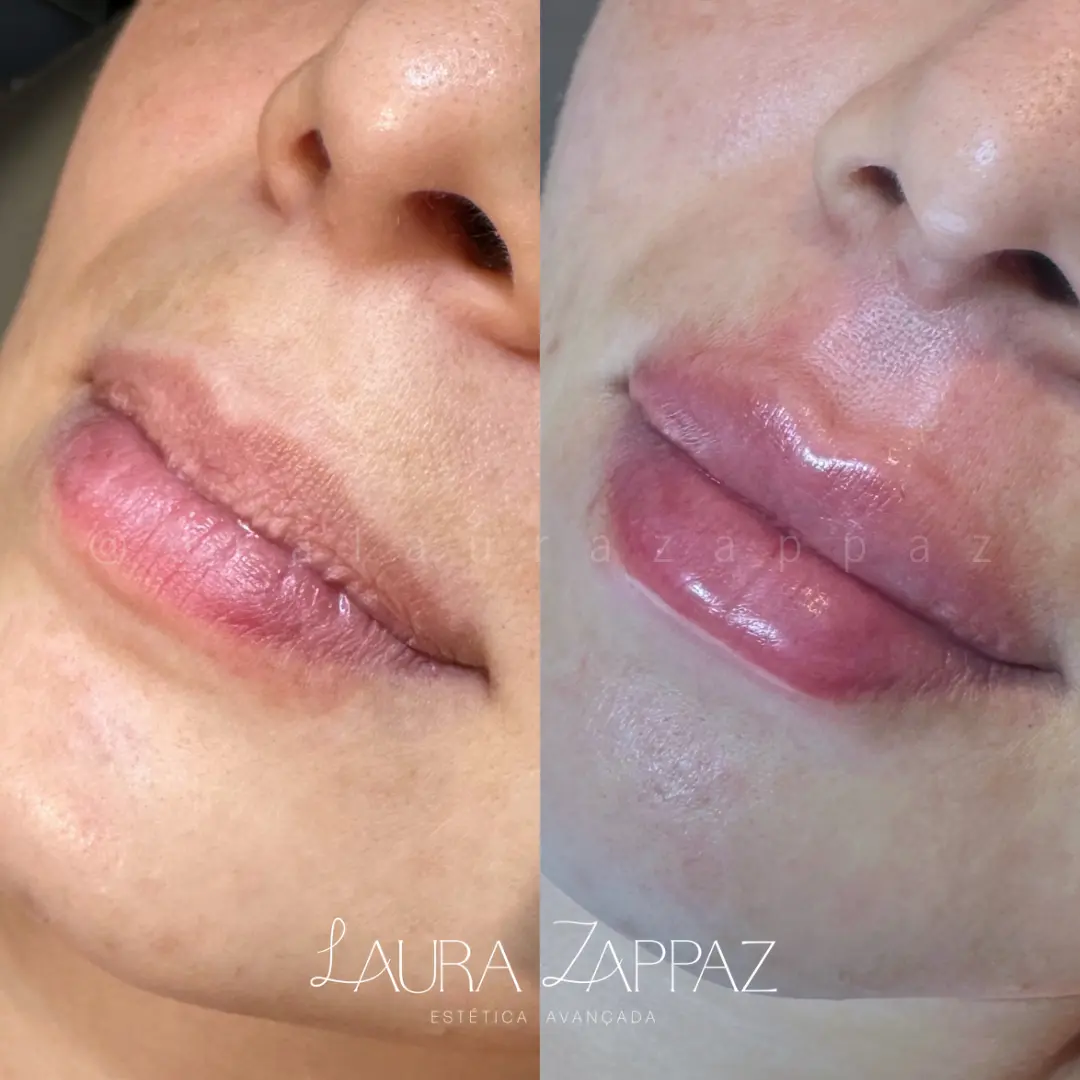 14 - Preenchimento labial