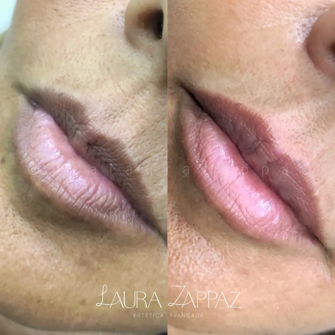 16 - Preenchimento labial
