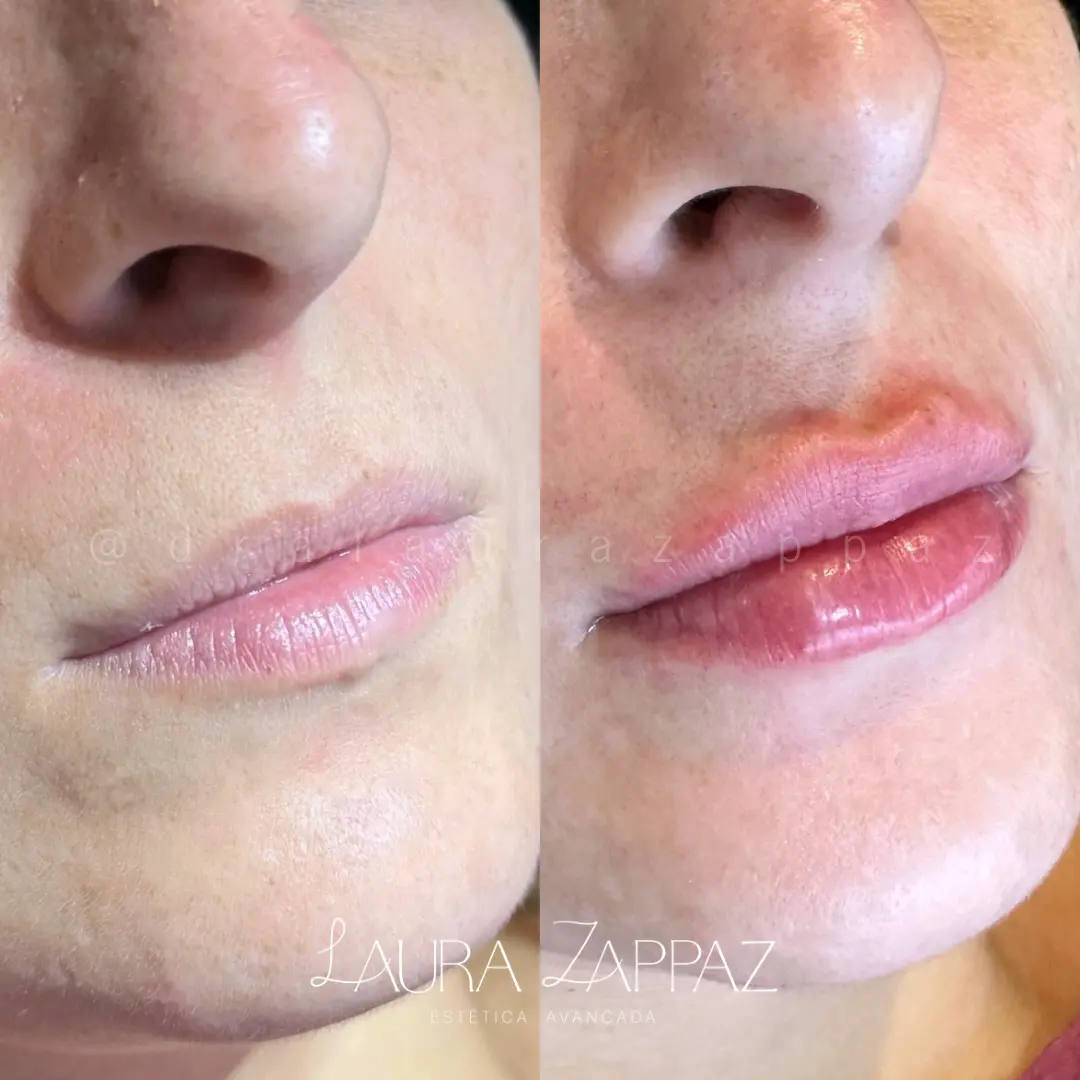 19 - Preenchimento labial