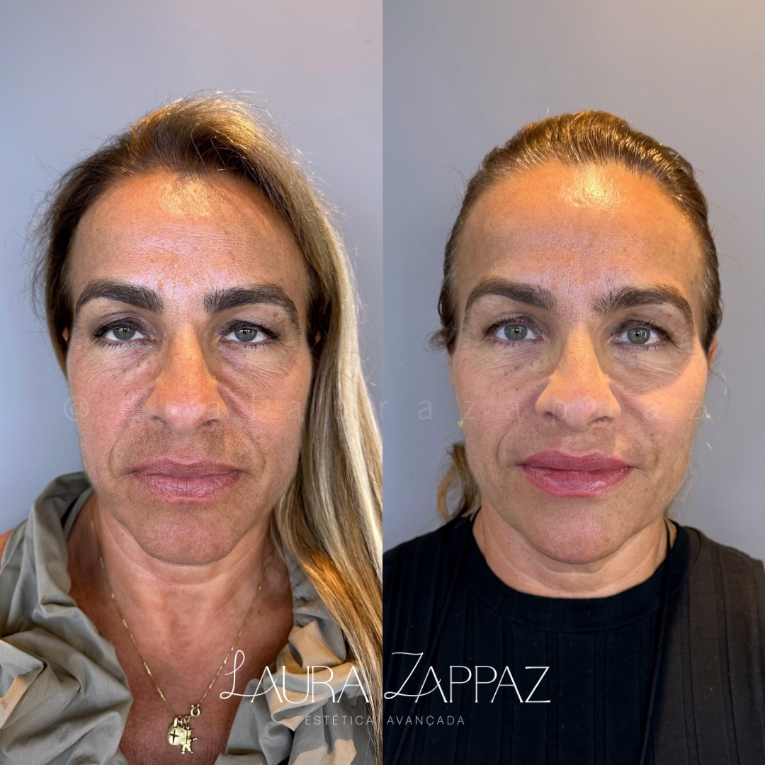 2-Harmonização-full-face
