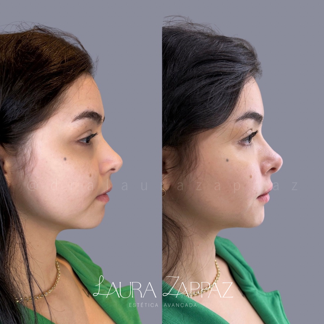 3-Perfiloplastia-não-cirúrgica