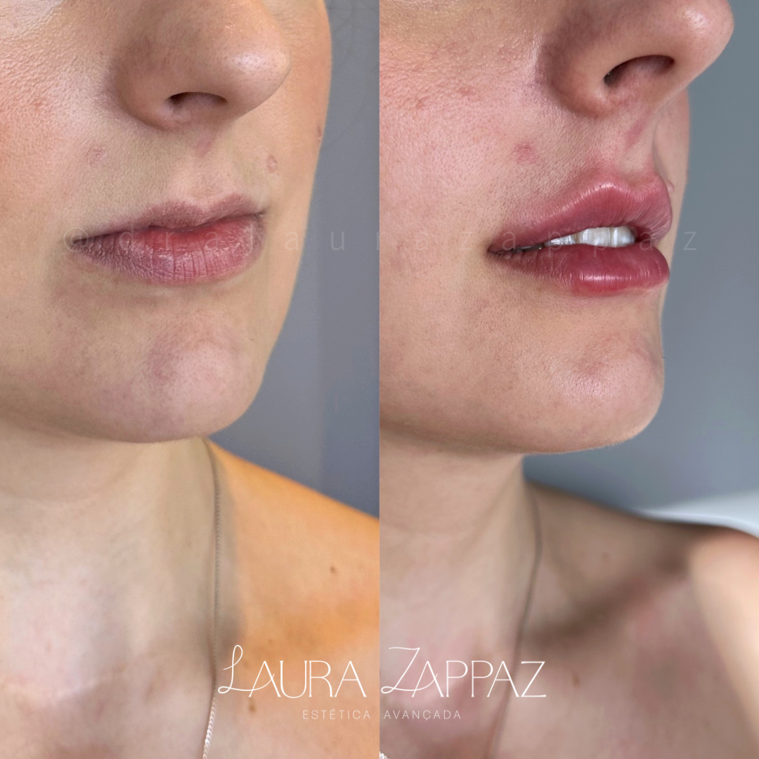 4-Preenchimento-labial
