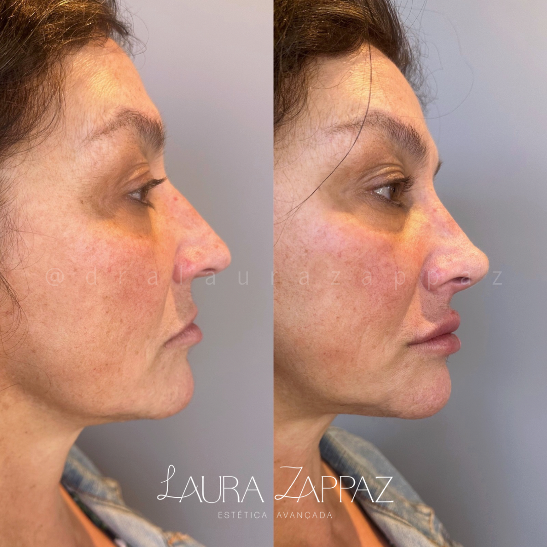 5-Rinomodelação-e-preenchimento-labial