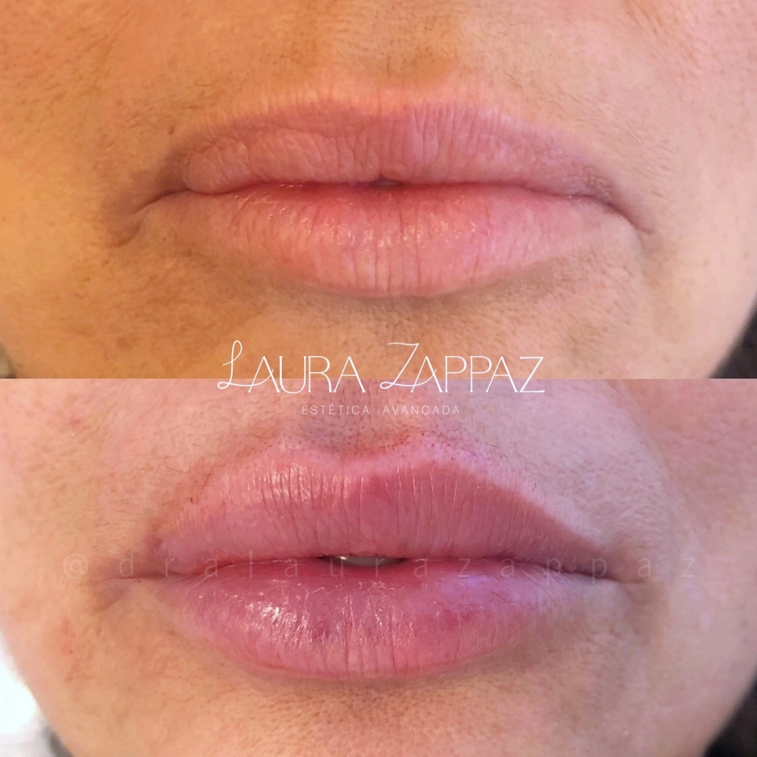 7-Preenchimento-labial