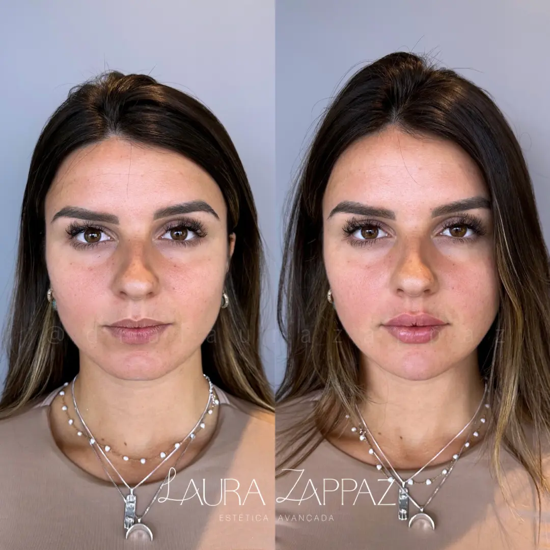 9 - Preenchimento labial e mento (queixo)